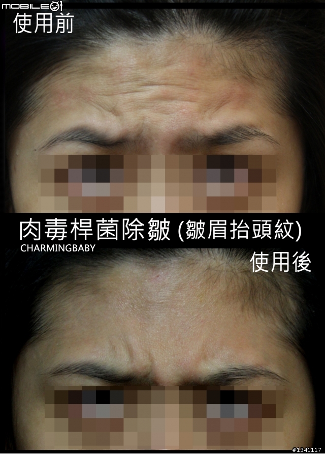 玻尿酸(水微晶)試打心得+肉毒桿菌除皺心得