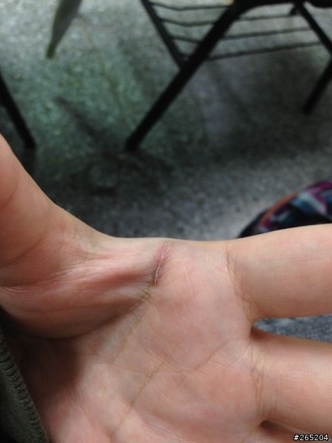 被水刀子割傷，有多餘的皮如何處裡？