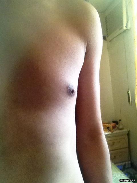 請問一下...胸部外側下方乳頭部分外擴要怎麼救阿@@? (有圖)