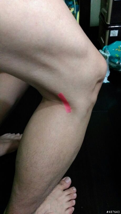 右膝蓋右後側肌腱痛?