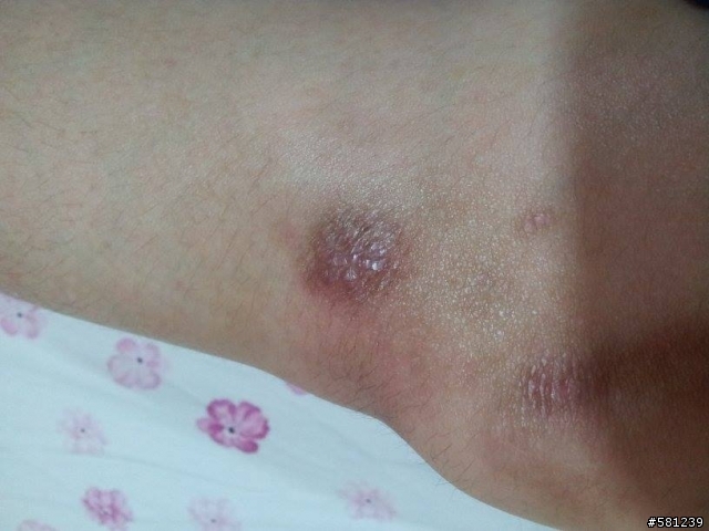 傷口復原程度(有圖注意)