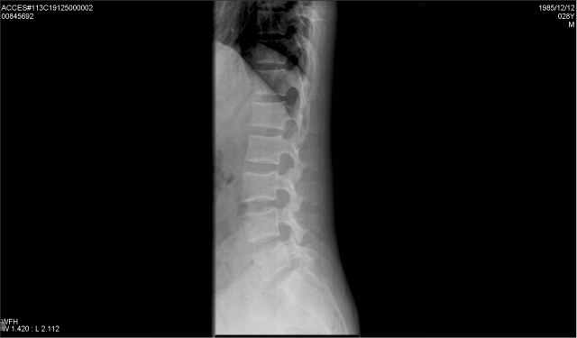 關於椎間盤突出與梨狀肌症候群(補上MRI 以及X光)
