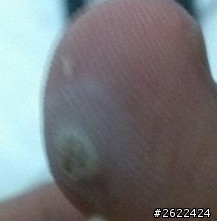 腳趾頭長白白的一顆東西