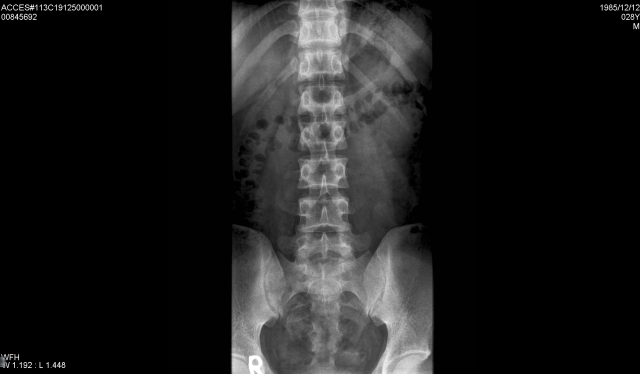 關於椎間盤突出與梨狀肌症候群(補上MRI 以及X光)