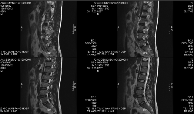 關於椎間盤突出與梨狀肌症候群(補上MRI 以及X光)