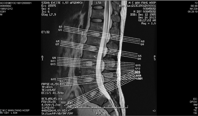 關於椎間盤突出與梨狀肌症候群(補上MRI 以及X光)
