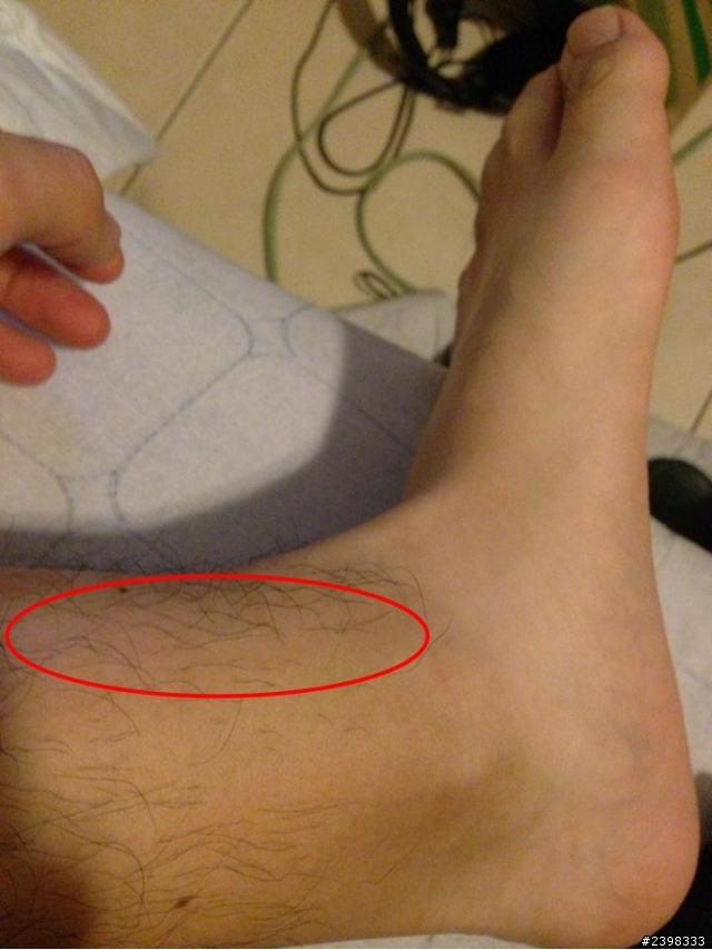 想問腳踝受傷的事情