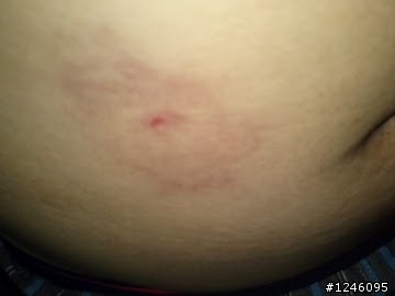 小弟有時被蚊子咬,竟變成這樣,內有美照,愼入