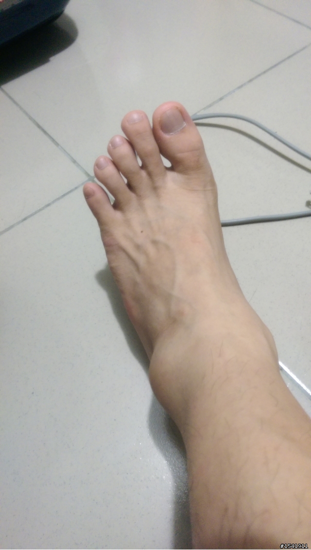 腳扭傷成這樣還可以出國嗎