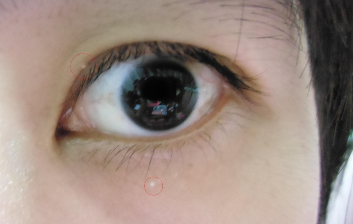 眼皮上下長粉刺了 要怎麼清除它(附照片)原來有3顆= =