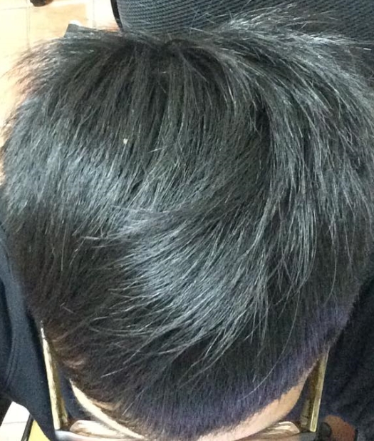 請問有M型禿現在該怎麼辦?