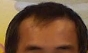 請問有M型禿現在該怎麼辦?