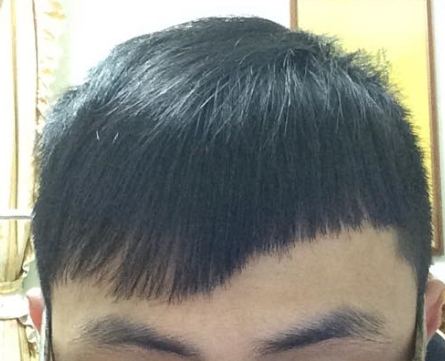 請問有M型禿現在該怎麼辦?