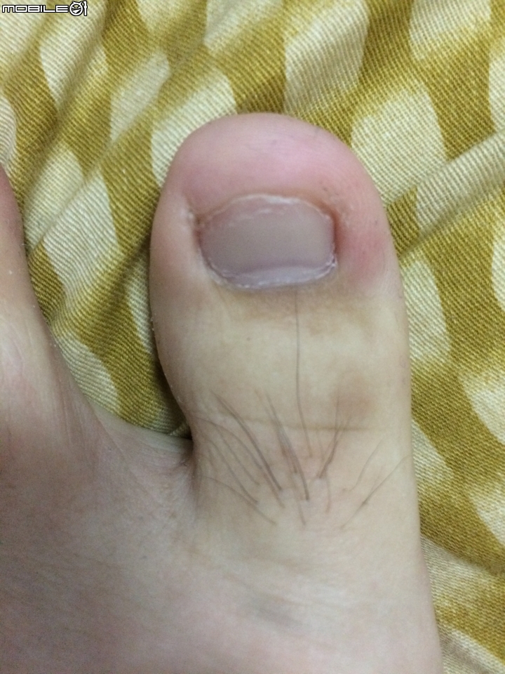 甲溝炎(凍甲)?   有圖
