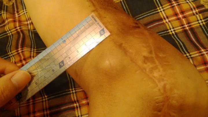 曾得過癌症,但病情穩定後,又隔差不多的時間,又再長出不好的東西……,該如何保養身體及建議??(文長+圖)