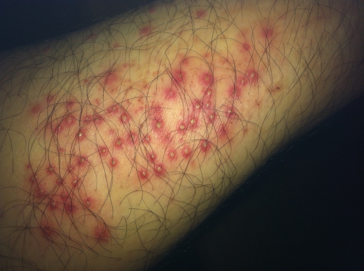 [恐怖慎入]小腿整片痘痘