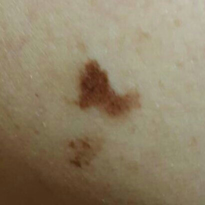 不明瘀青