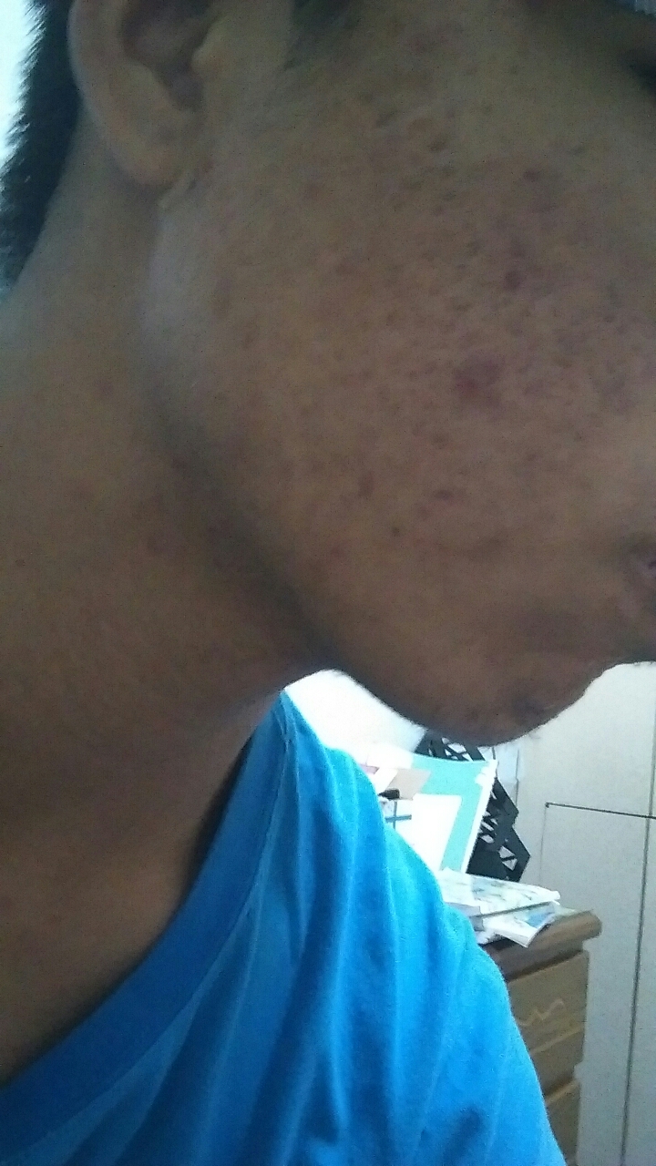 [求救]我的臉這樣有什麼方法可以補救