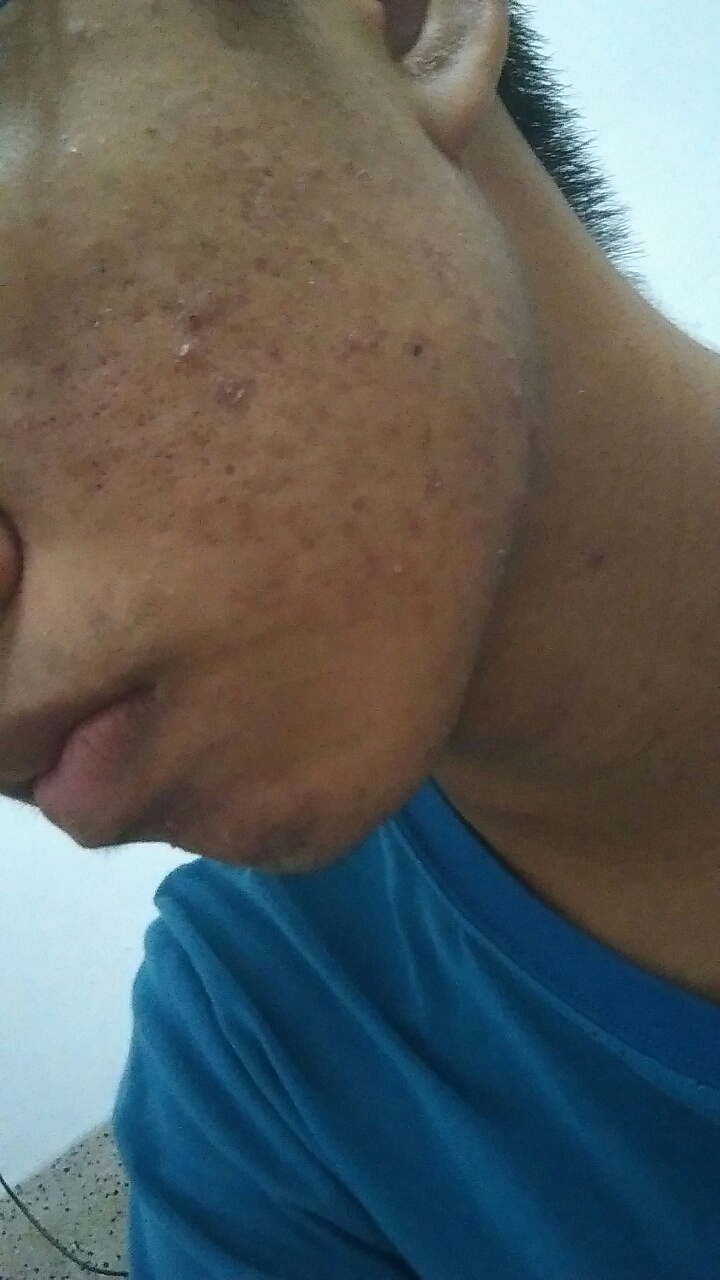 [求救]我的臉這樣有什麼方法可以補救