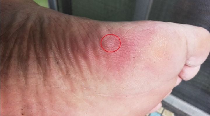 腳掌起水泡，和鞋子鬆緊有關嗎？
