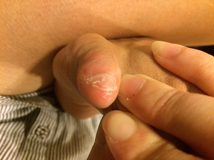 腳趾甲分層脫落