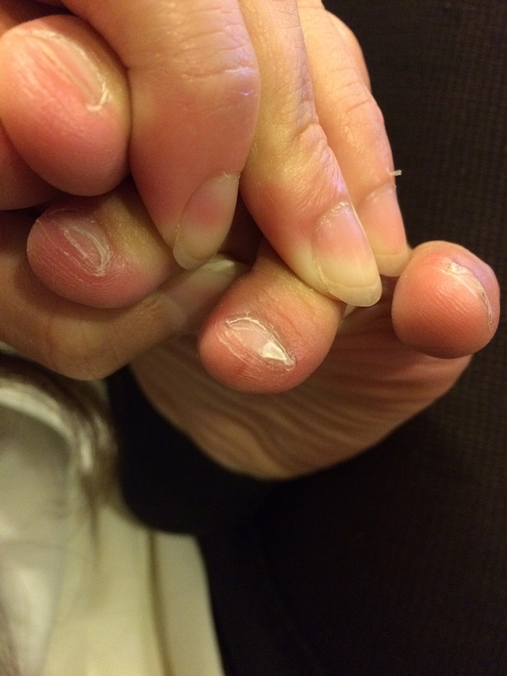 腳趾甲分層脫落