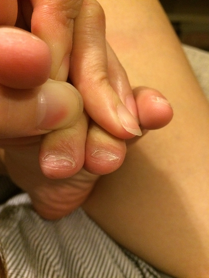 腳趾甲分層脫落