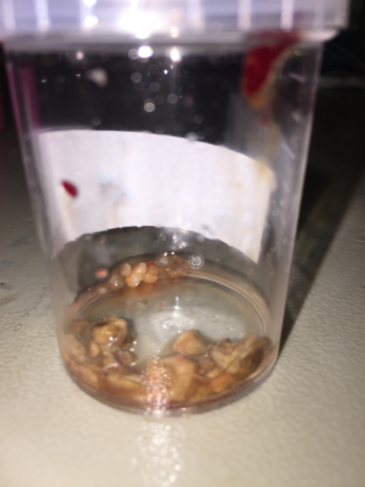 非常難纏的腎臟結石問題..(內有取出石頭，不喜勿進）