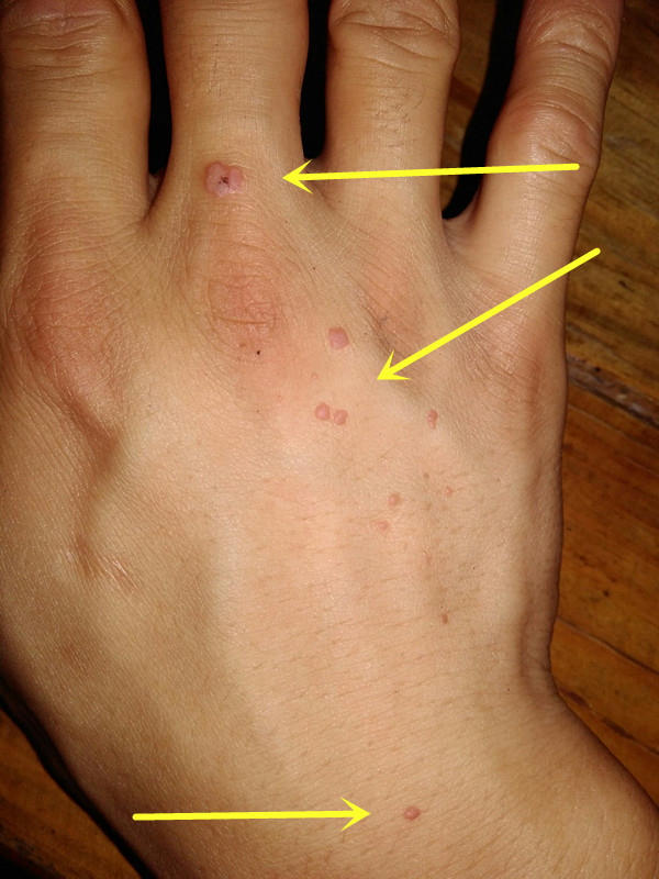 請問這是 肉芽/息肉嗎?!請教怎處裡...!?