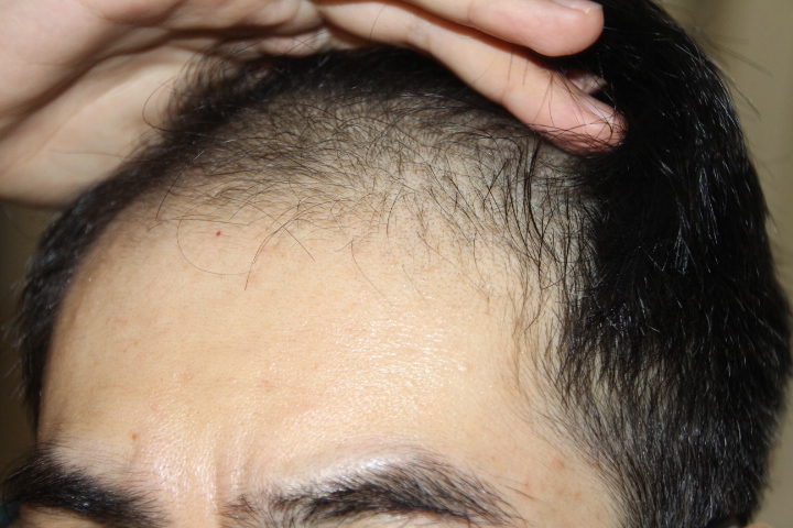 禿髮 毛囊炎？ 雄性禿？