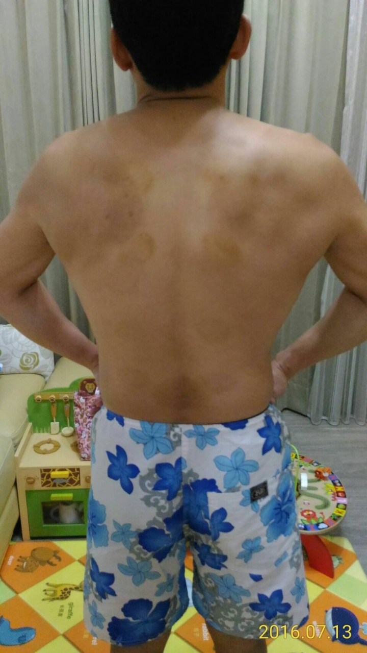 請問背闊肌左右大小不一樣，要怎麼訓練補強?