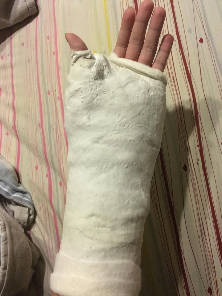 手腕骨折打石膏疑問