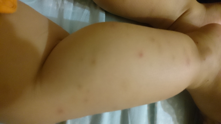 腸病毒還是玫瑰疹或腸胃炎？