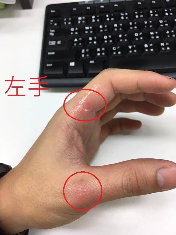 請教各位前輩,關於打擊手破皮的部位