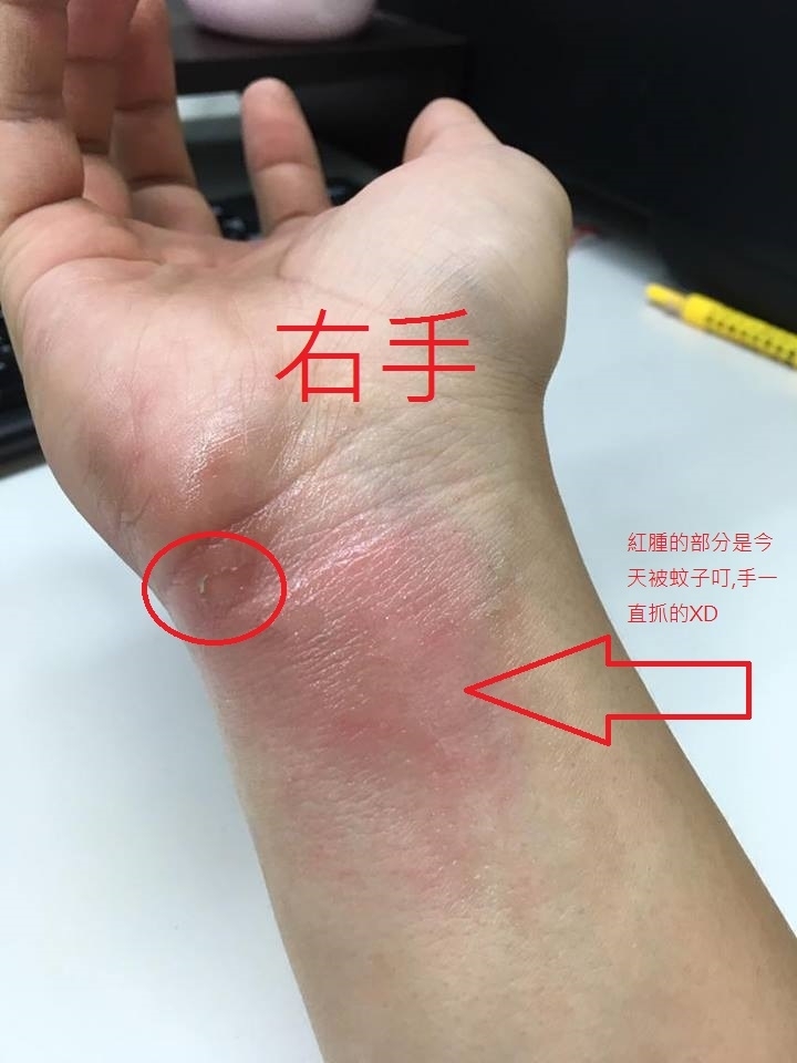 請教各位前輩,關於打擊手破皮的部位