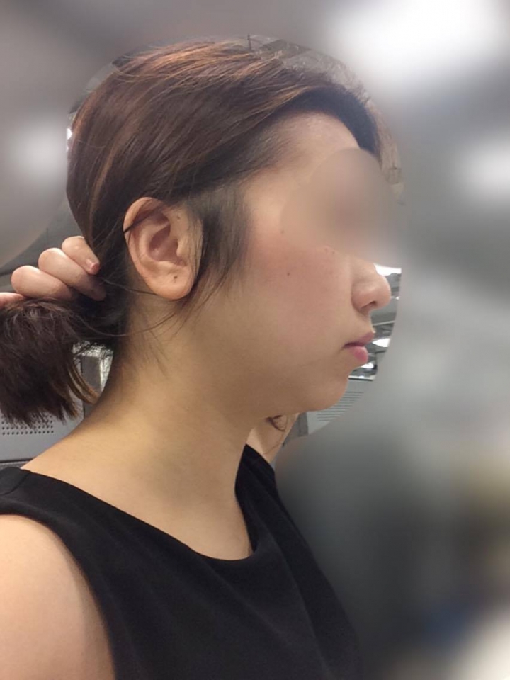 體脂26 非常嚴重雙下巴 怎麼解救?