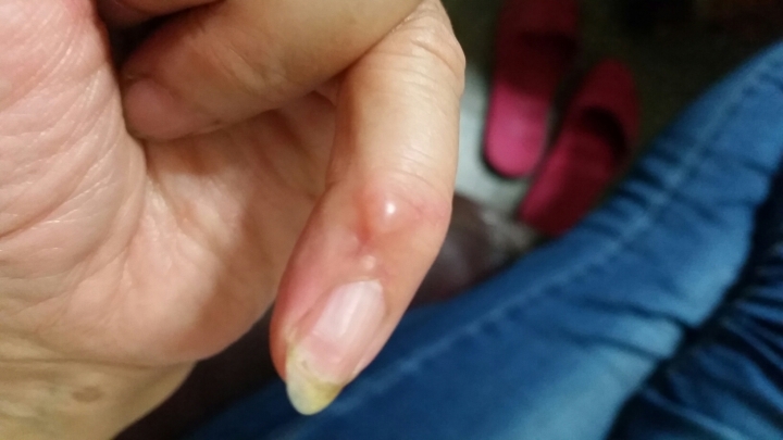 請問這是什麼？疣嗎？