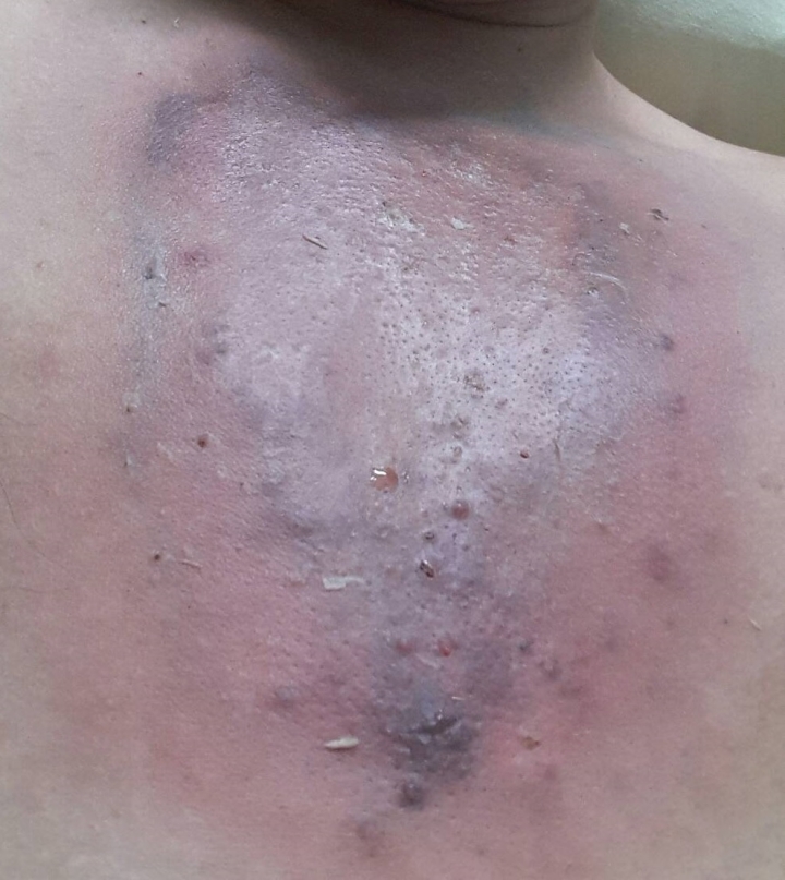 大醫院醫生都檢查不出的皮膚病(內有圖)
