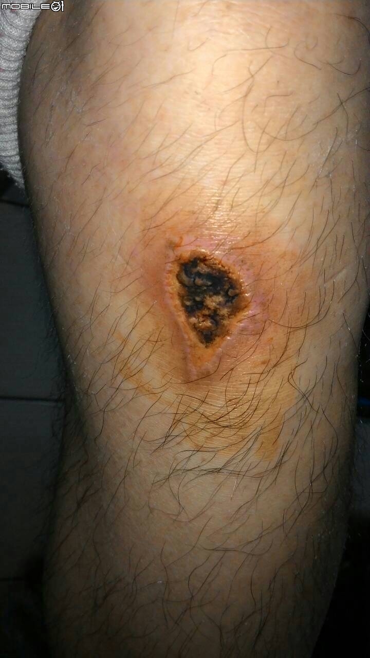 爬山過後，左膝蓋走路會痛...