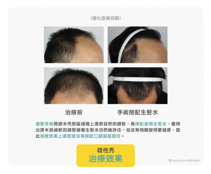 轉 醫師團隊用心整理：雄性禿的分期判斷及治療方式（附圖）