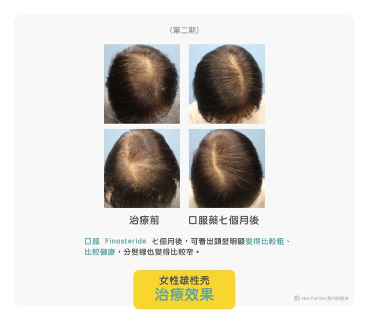 轉 醫師團隊用心整理：雄性禿的分期判斷及治療方式（附圖）