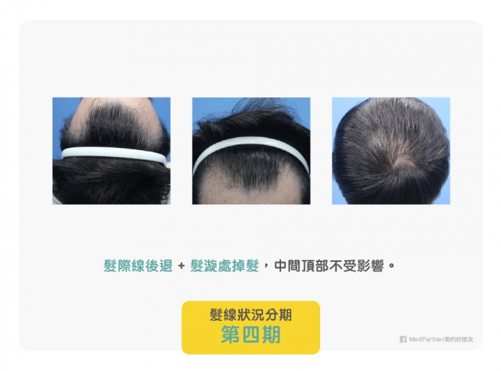 轉 醫師團隊用心整理：雄性禿的分期判斷及治療方式（附圖）