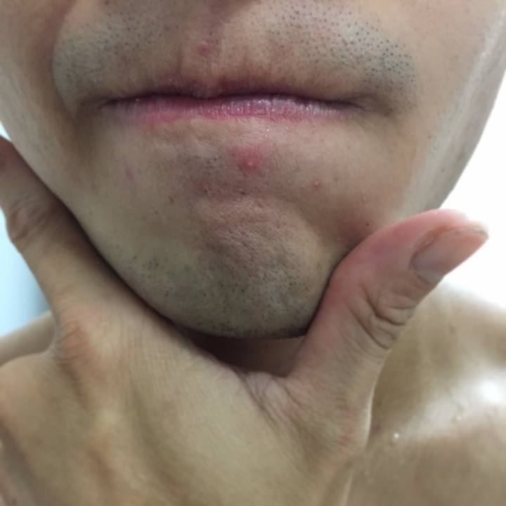 【開箱實測】抗痘14天親身實驗報告 男研堂 HODR MEN\