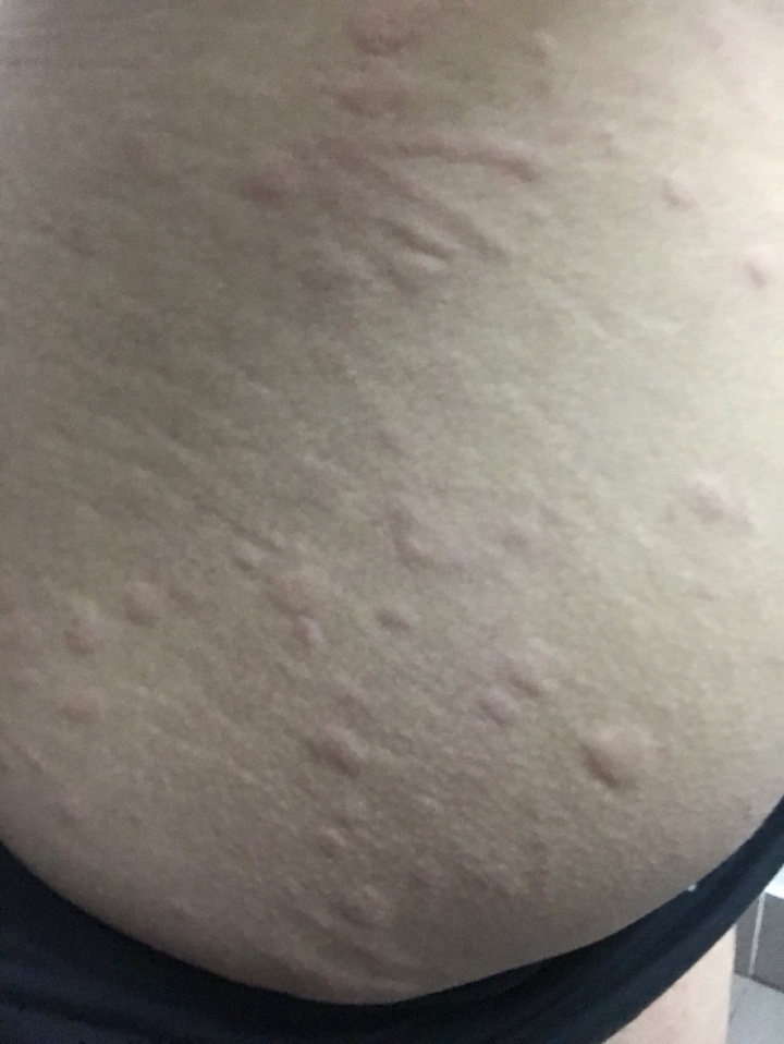 被狗的壁蝨咬全身該怎麼處理(照片慎入