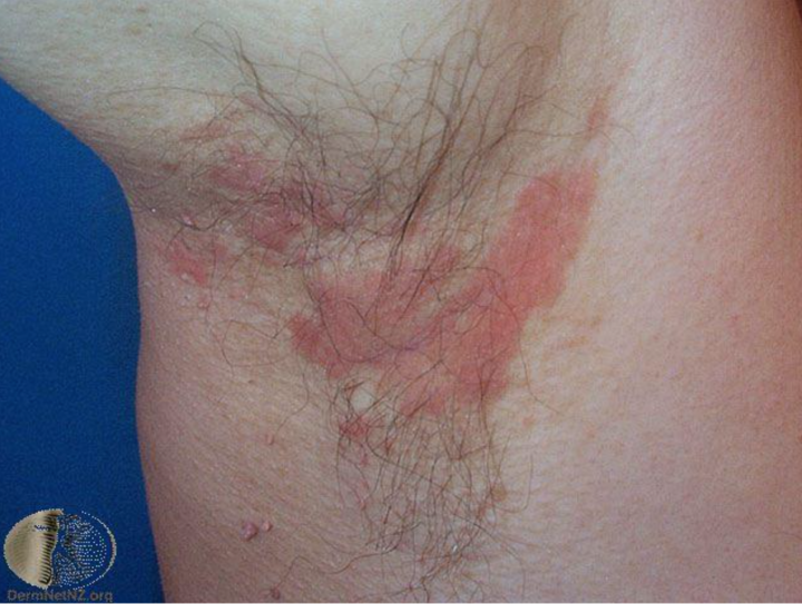 ＃轉 醫師團隊熱心分享：脂漏性皮膚炎保養根治全攻略