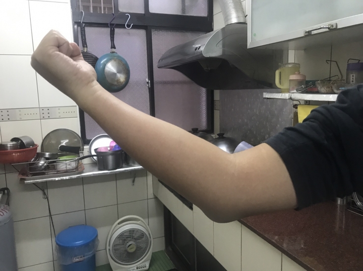 蜂窩性組織炎-分享