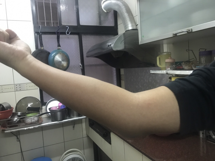 蜂窩性組織炎-分享