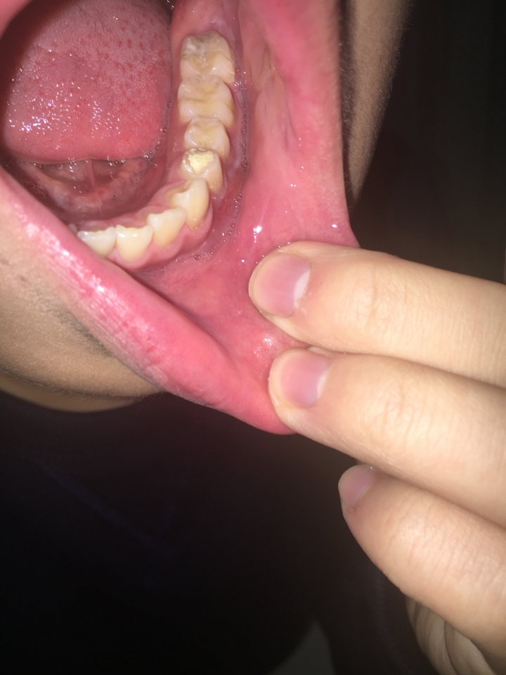 剛做根管治療 一邊臉腫起來 急急急！