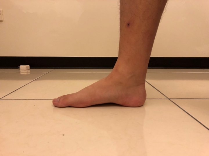[分享]足底筋膜炎的救星