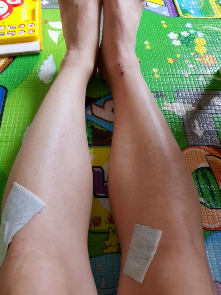 跑步過程左腳小腿腫像抽筋感覺